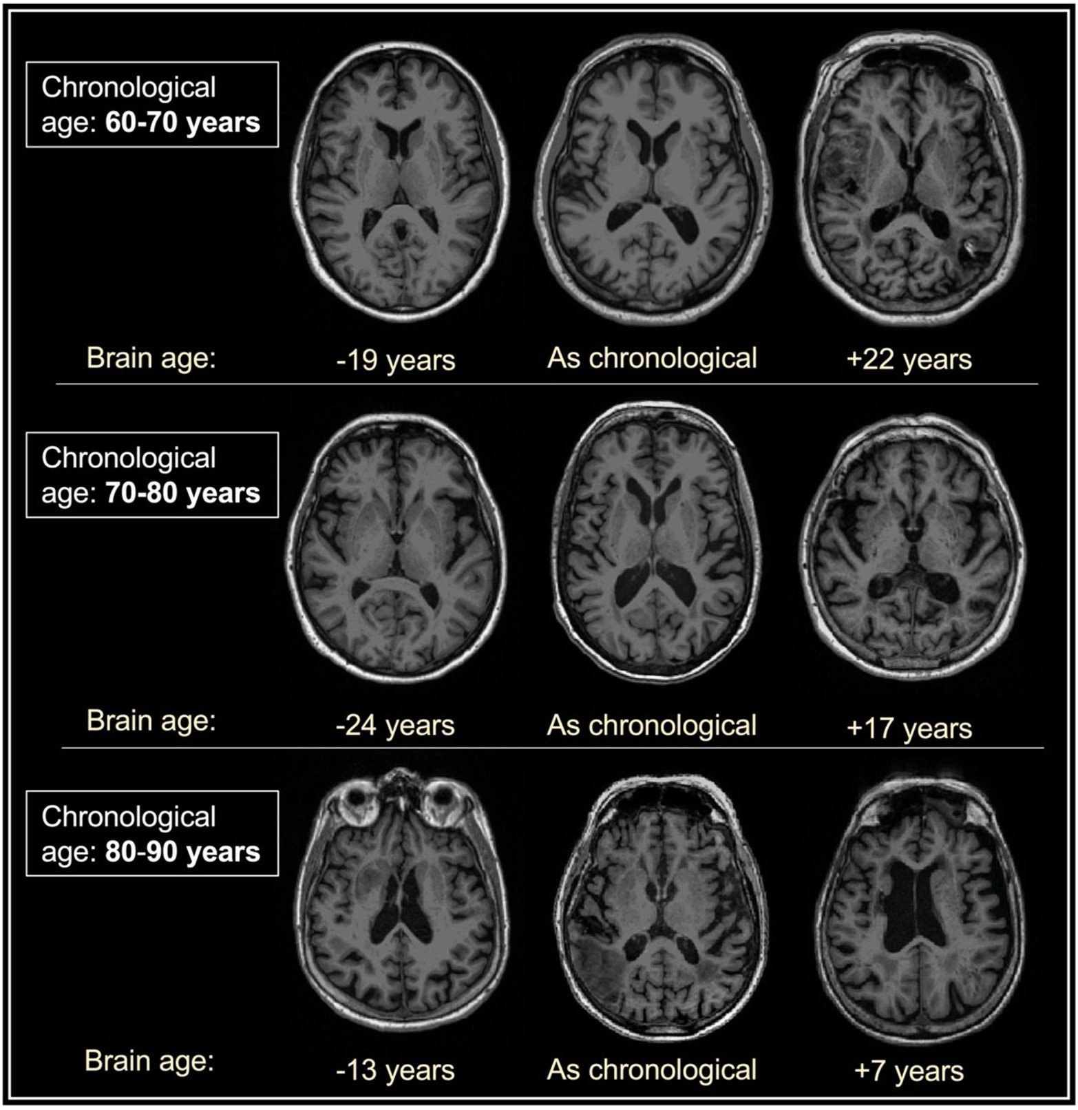 Axial MRI slices from individuals in three chronological age bands, showing markedly different brain structure within each band